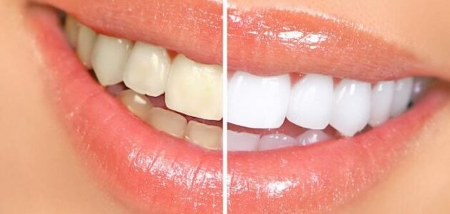 Common Causes of Tooth Discoloration