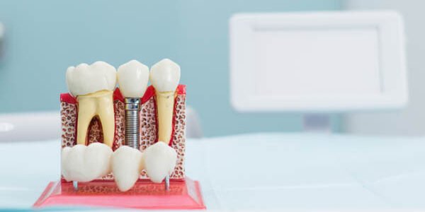 Making the Right Choice: Dental Implants vs. Other Tooth Replacement Methods