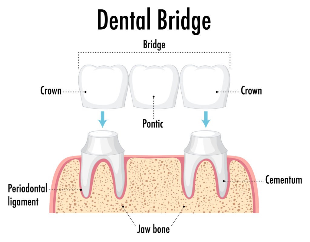 Crown and Bridge Treatment