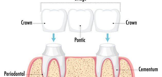 The Ultimate Solution for Missing Teeth: Crown & Bridge Treatment in Kalyani Nagar, Pune