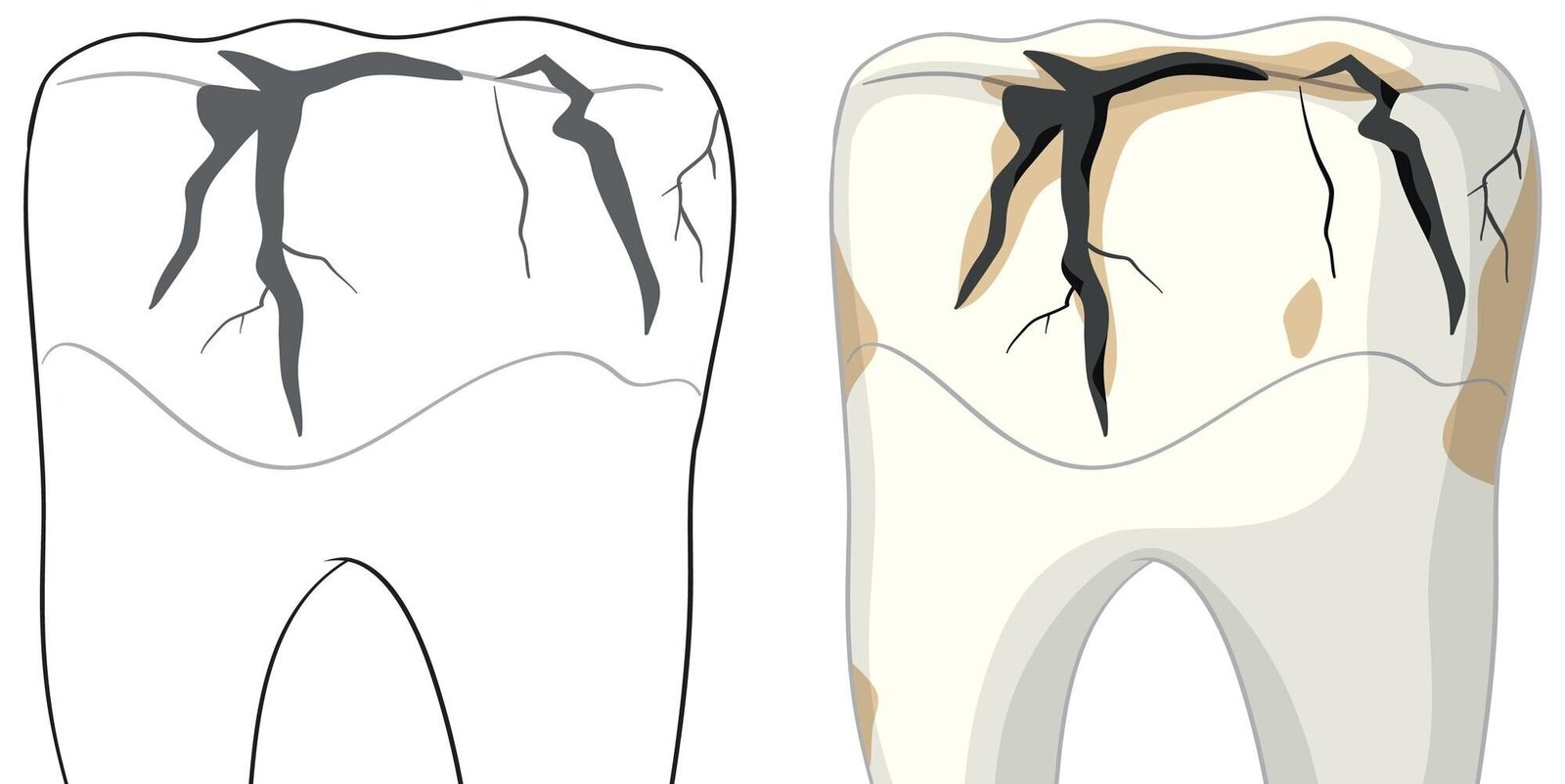 Broken tooth treatment at Dr. Thareja’s Dental Care, Pune.